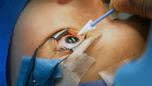 CLE Eyes Surgery